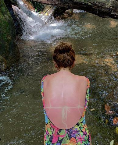 Bruna Linzmeyer com queimadura de sol