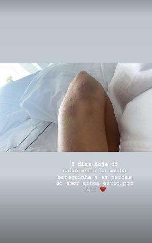 Romana Novais exibe hematomas após parto de risco