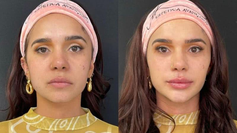 Gizelly Bicalho faz harmonização facial - Reprodução/Instagram