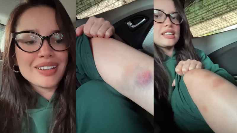 Juliette mostra hematomas e explica motivo - Foto: Reprodução/Instagram