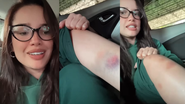 Juliette mostra hematomas e explica motivo - Foto: Reprodução/Instagram