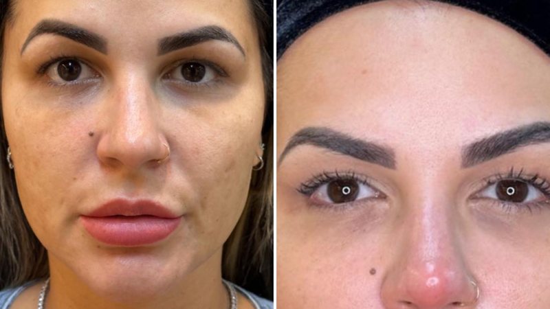 Mudança total! Deolane Bezerra surge após nova harmonização facial: "Refinamento" - Reprodução/ Instagram