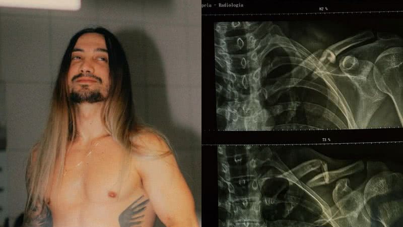 Guitarrista do Nx Zero, Gee Rocha, fala sobre acidente que sofreu de moto e será submetido a cirurgia - Foto: Reprodução / Instagram