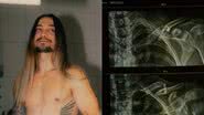 Guitarrista do Nx Zero, Gee Rocha, fala sobre acidente que sofreu de moto e será submetido a cirurgia - Foto: Reprodução / Instagram