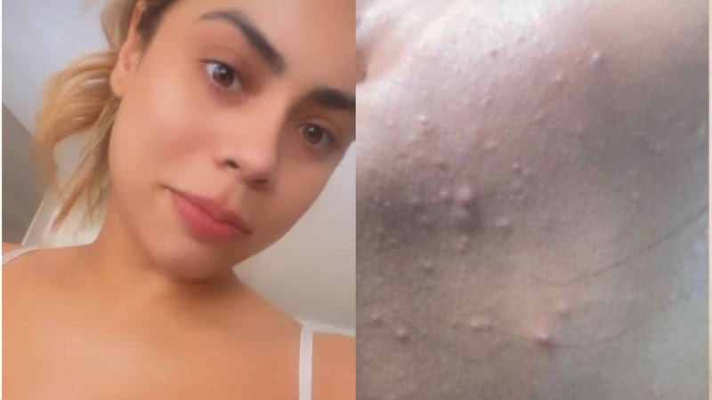 Lexa choca ao mostrar antes e depois de sua pele - Reprodução/Instagram