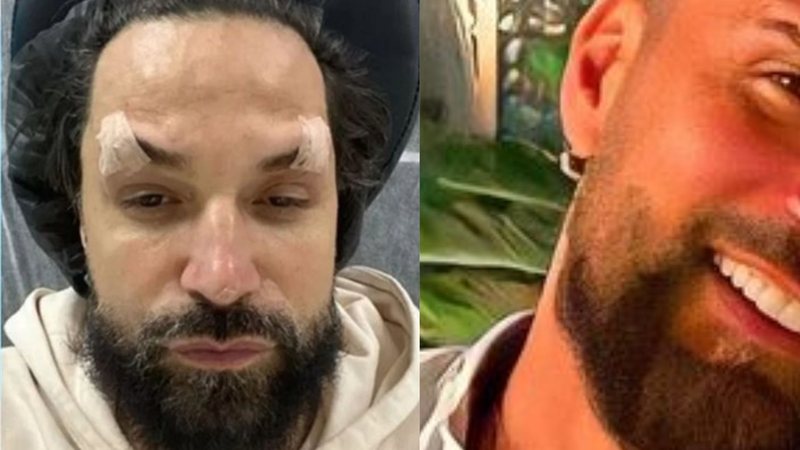 Latino surpreende ao exibir resultado final da harmonização facial - Foto: Reprodução/Instagram