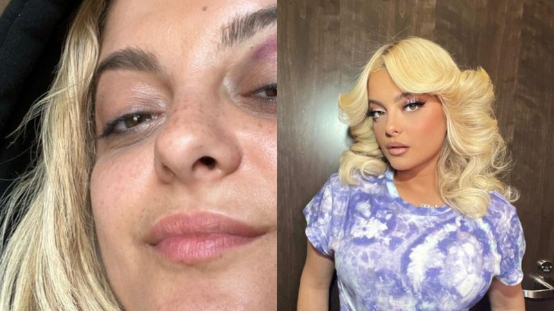 Cantora Bebe Rexha aparece com olho roxo após ser atingida no rosto com celular enquanto se apresentava - Foto: Reprodução / Instagram