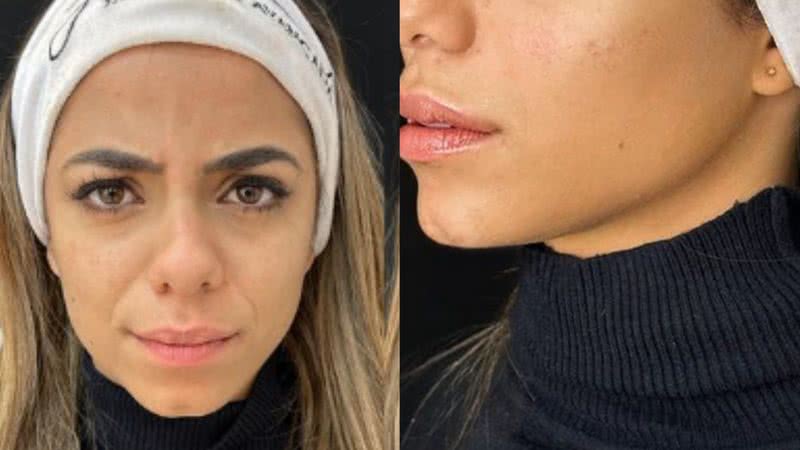 Ex-BBB Key Alves realiza harmonização facial - Reprodução/Instagram