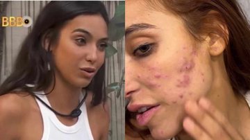 Ex-BBB Vanessa Lopes mostra seu rosto com acne - Reprodução/Instagram