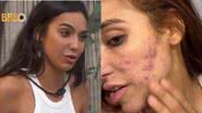 Ex-BBB Vanessa Lopes mostra seu rosto com acne - Reprodução/Instagram