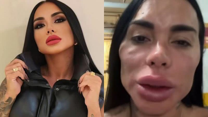 Kamila Simione antes e depois da harmonização facial - Reprodução/Instagram