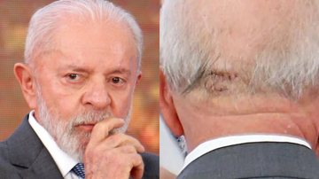 Lula e a cicatriz do tombo no banheiro: sangramento posterior pressionou o cérebro - Fotos: Getty Images