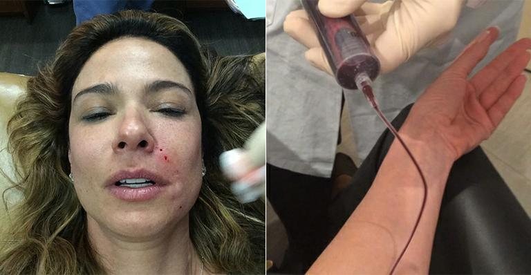 Luciana Gimenez faz tratamento estético com sangue - Instagram/Reprodução