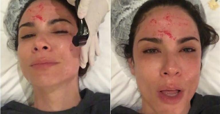 Com sangue no rosto, Luciana Gimenez reclama de dor em tratamento de beleza - Instagram/Reprodução