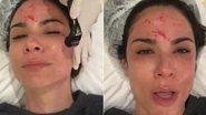 Com sangue no rosto, Luciana Gimenez reclama de dor em tratamento de beleza - Instagram/Reprodução