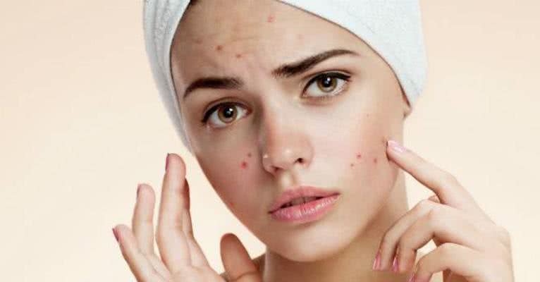 Acne: saiba quais alimentos estimulam o aparecimento - Shutterstock