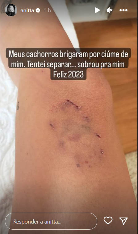 Anitta exibe hematoma na perna