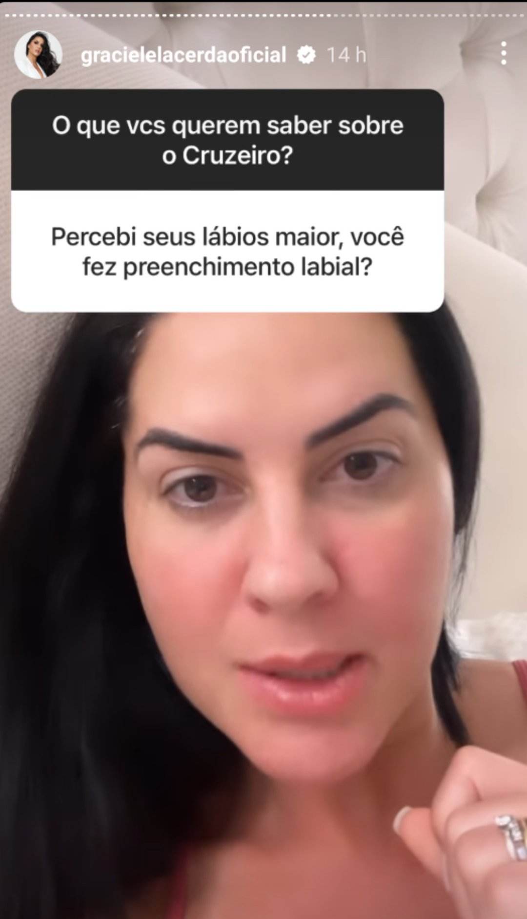 Graciele Lacerda fala sobre preenchimento labial