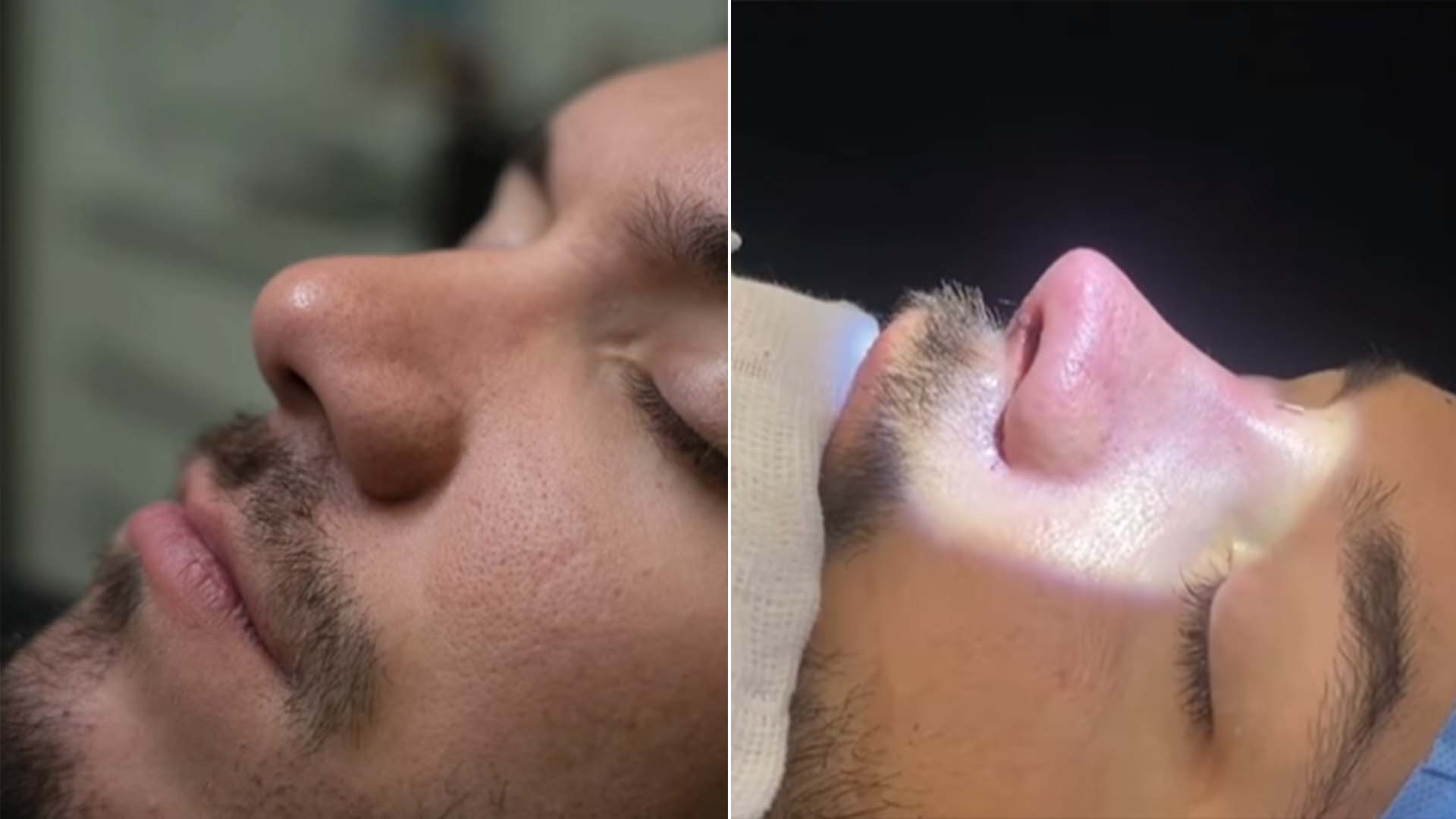 Antes e depois da rinoplastia de Eliezer - Crédito: Reprodução / Instagram