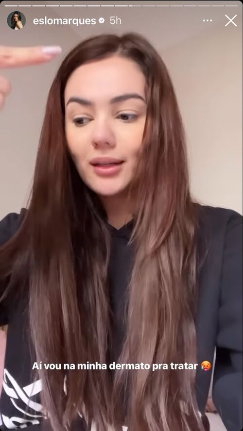 Eslovênia Marques revelou em seu Instagram que descobriu ter a doença autoimune alopecia. 