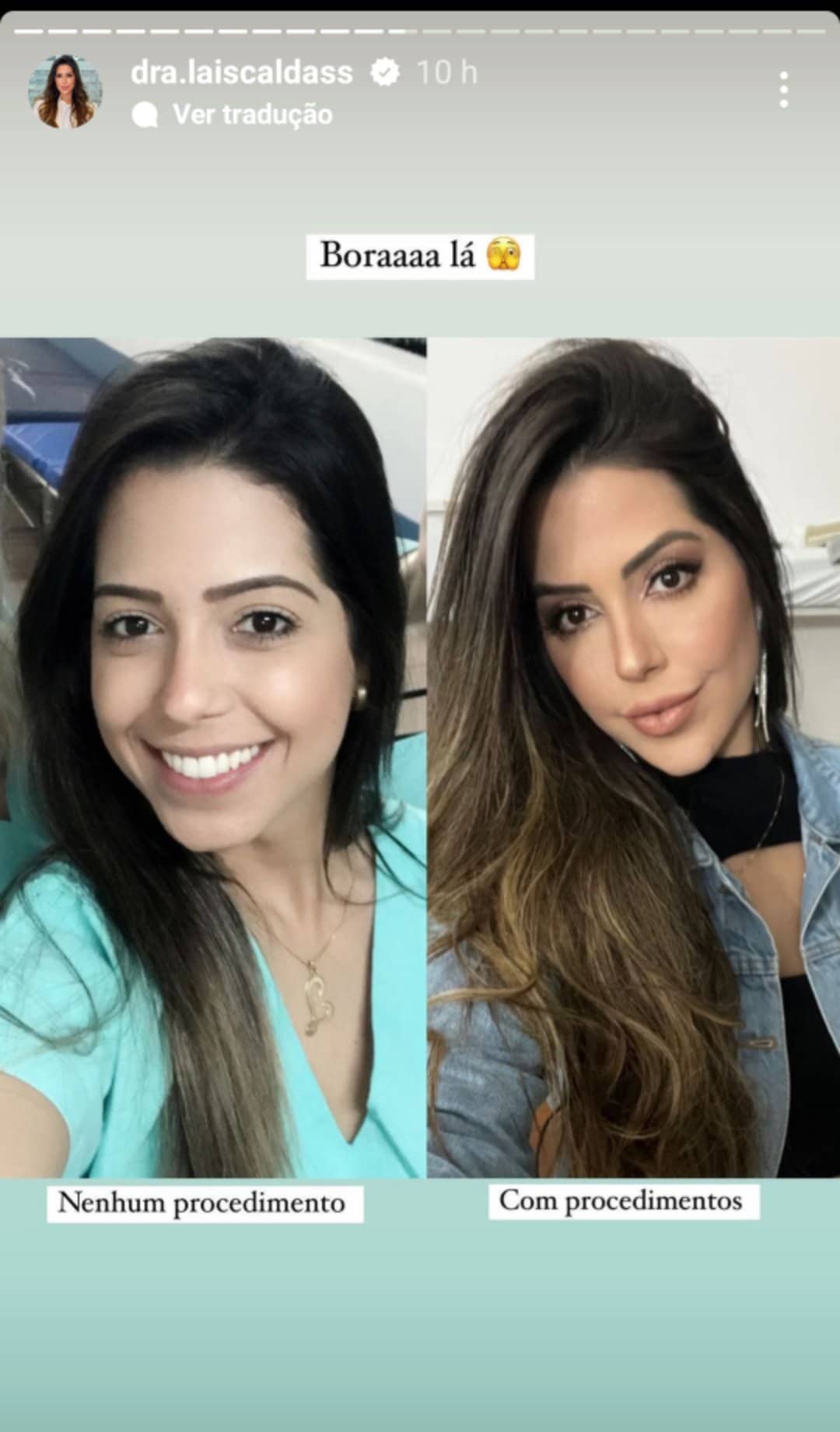 Laís Caldas antes e depois