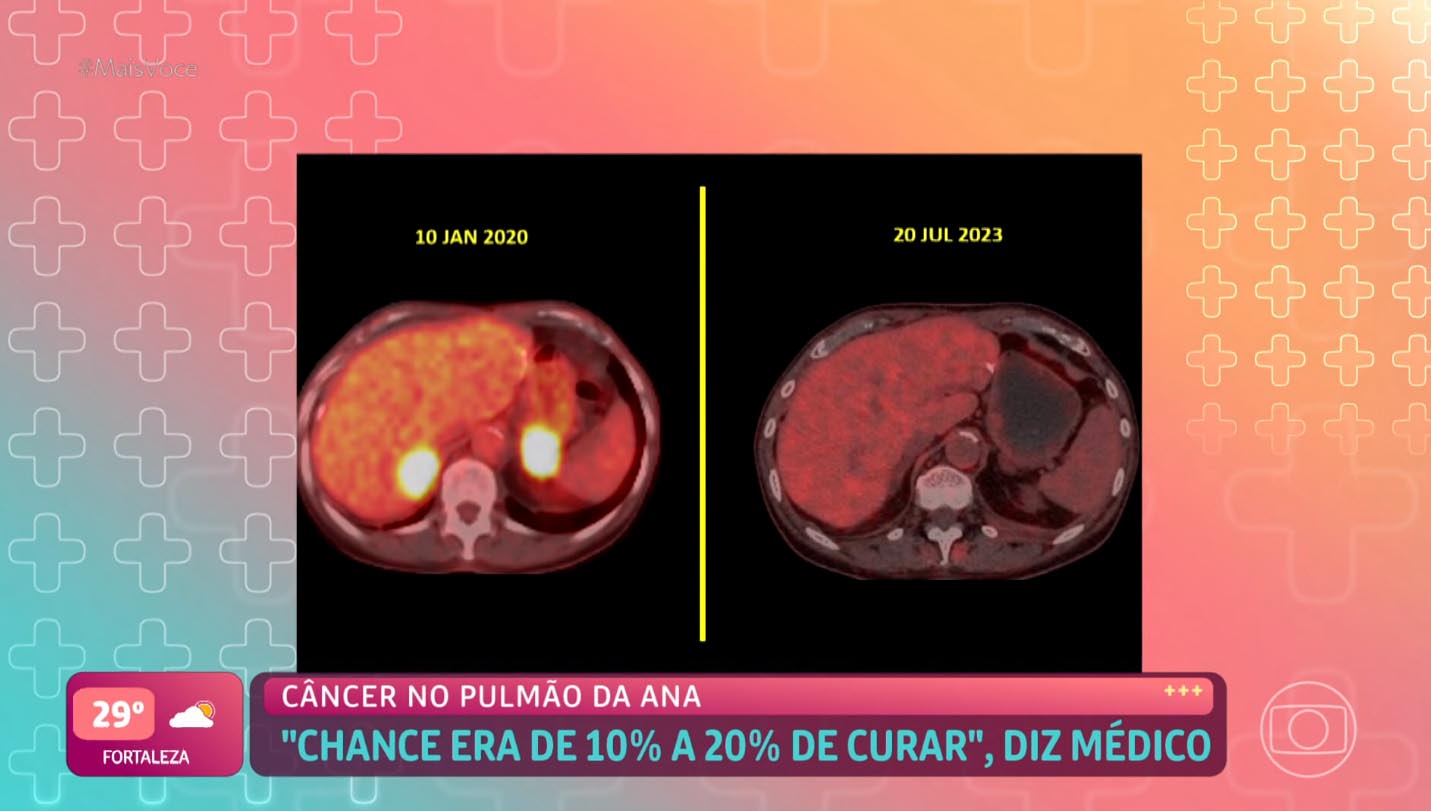 Ana Maria Braga exibe imagens dos seus exames durante a luta contra o câncer