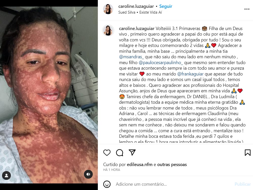 Mulher de Frank Aguiar surpreende ao mostrar o corpo coberto de manchas