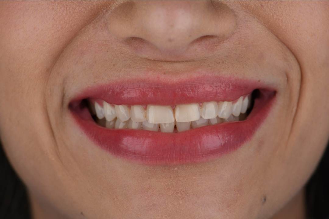 Jéssica Costa novos dentes