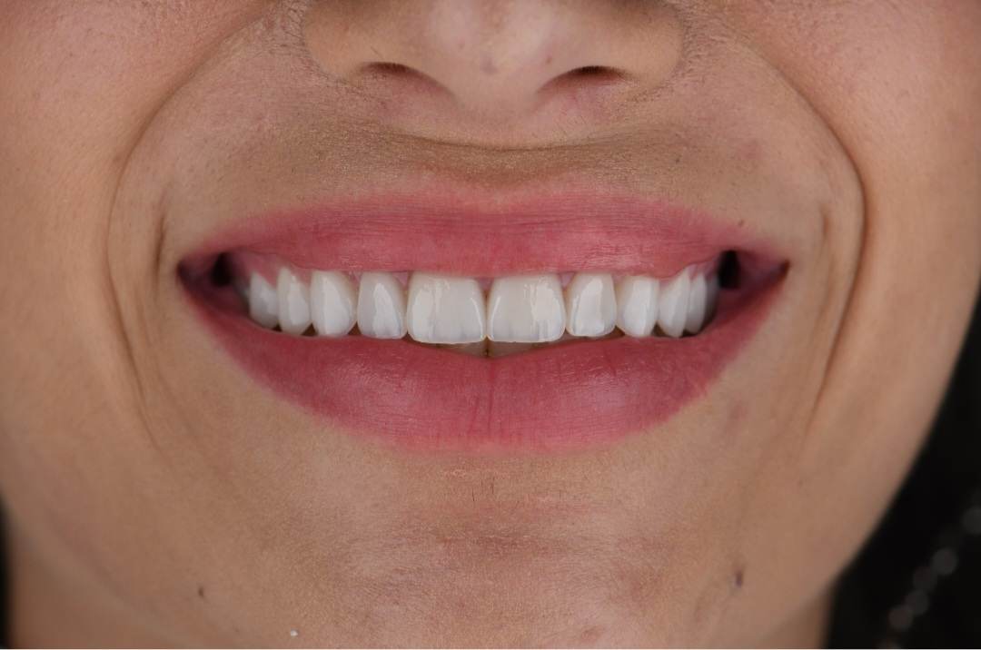 Jéssica Costa novos dentes