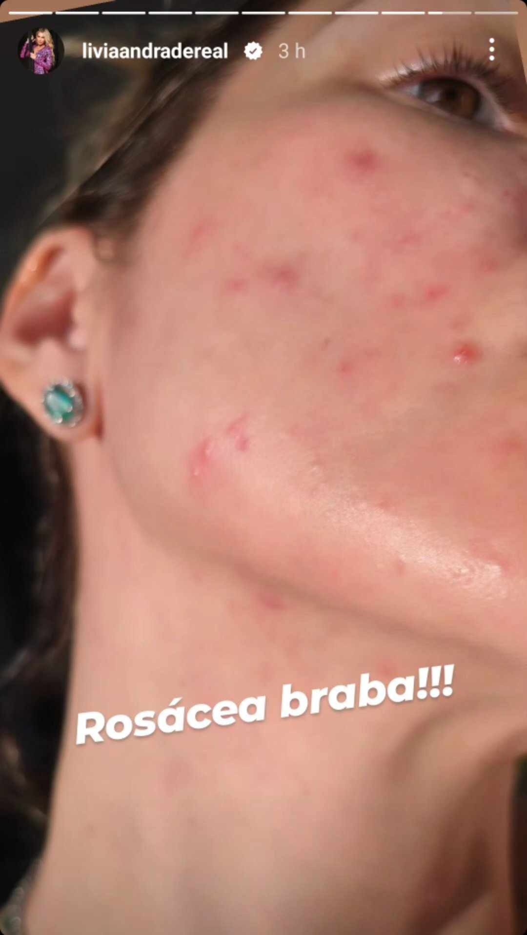 Lívia Andrade mostra rosácea