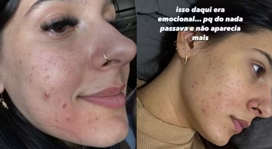 Ana Castela mostra antes e depois do rosto (Reprodução/Instagram)