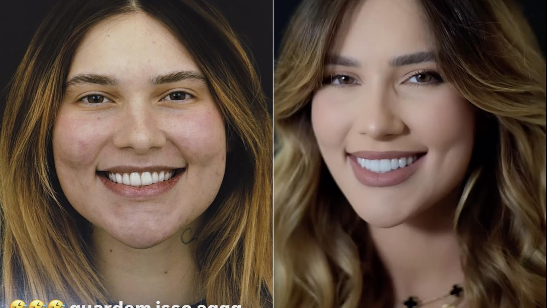 Fotos de antes e depois dos dentes de Virginia Fonseca - Foto: Reprodução / Instagram