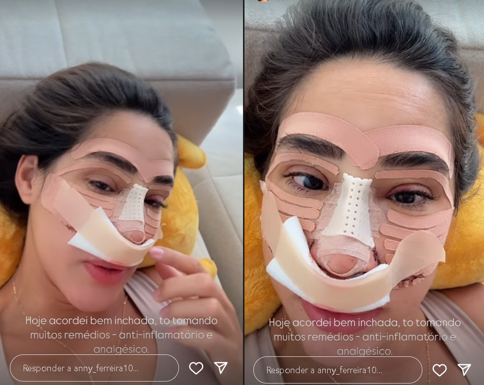 Deniziane Ferreira mostra o rosto após rinoplastia (Reprodução/Instagram) 