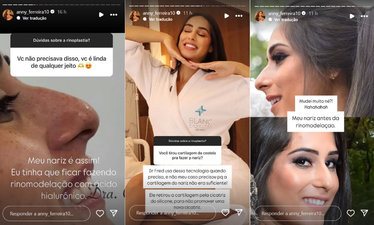 Ex-BBB Deniziane fala sobre rinoplastia - Reprodução / Instagram