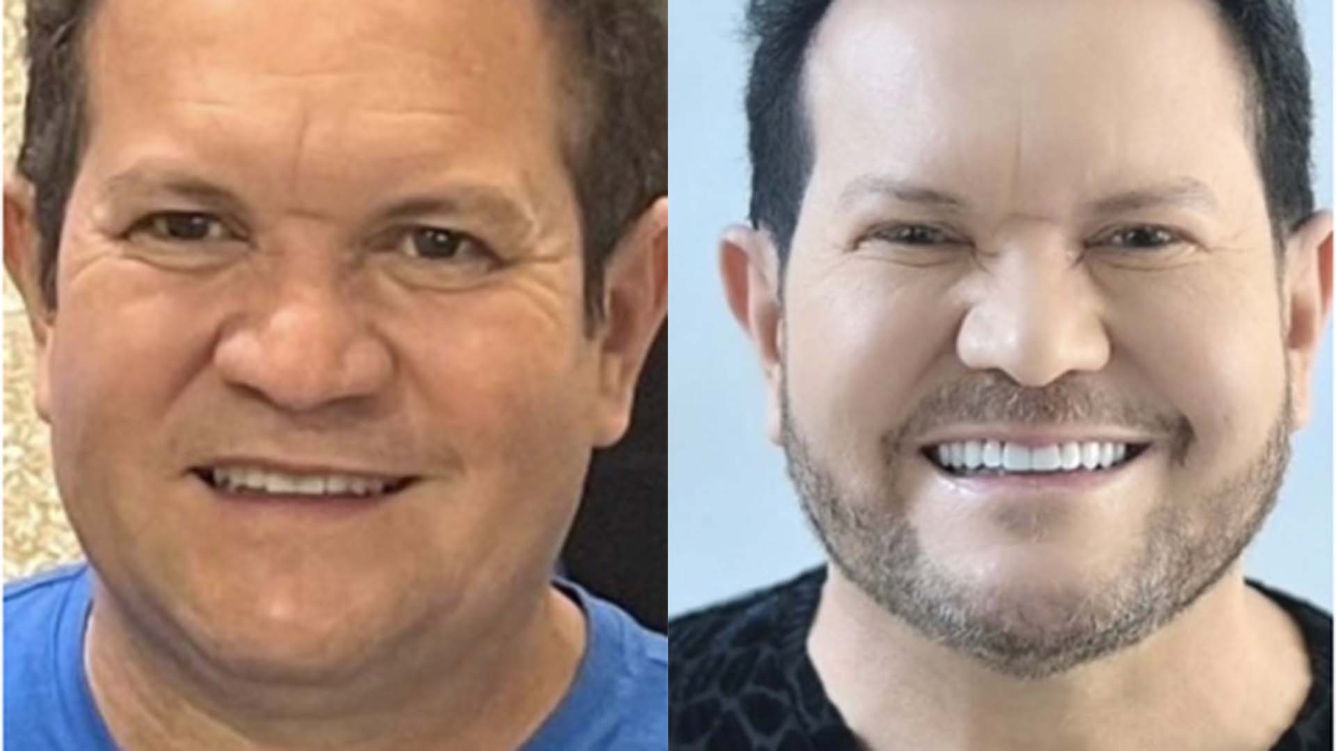 Ximbinha exibe resultado da harmonização facial - Foto: Reprodução / Instagram