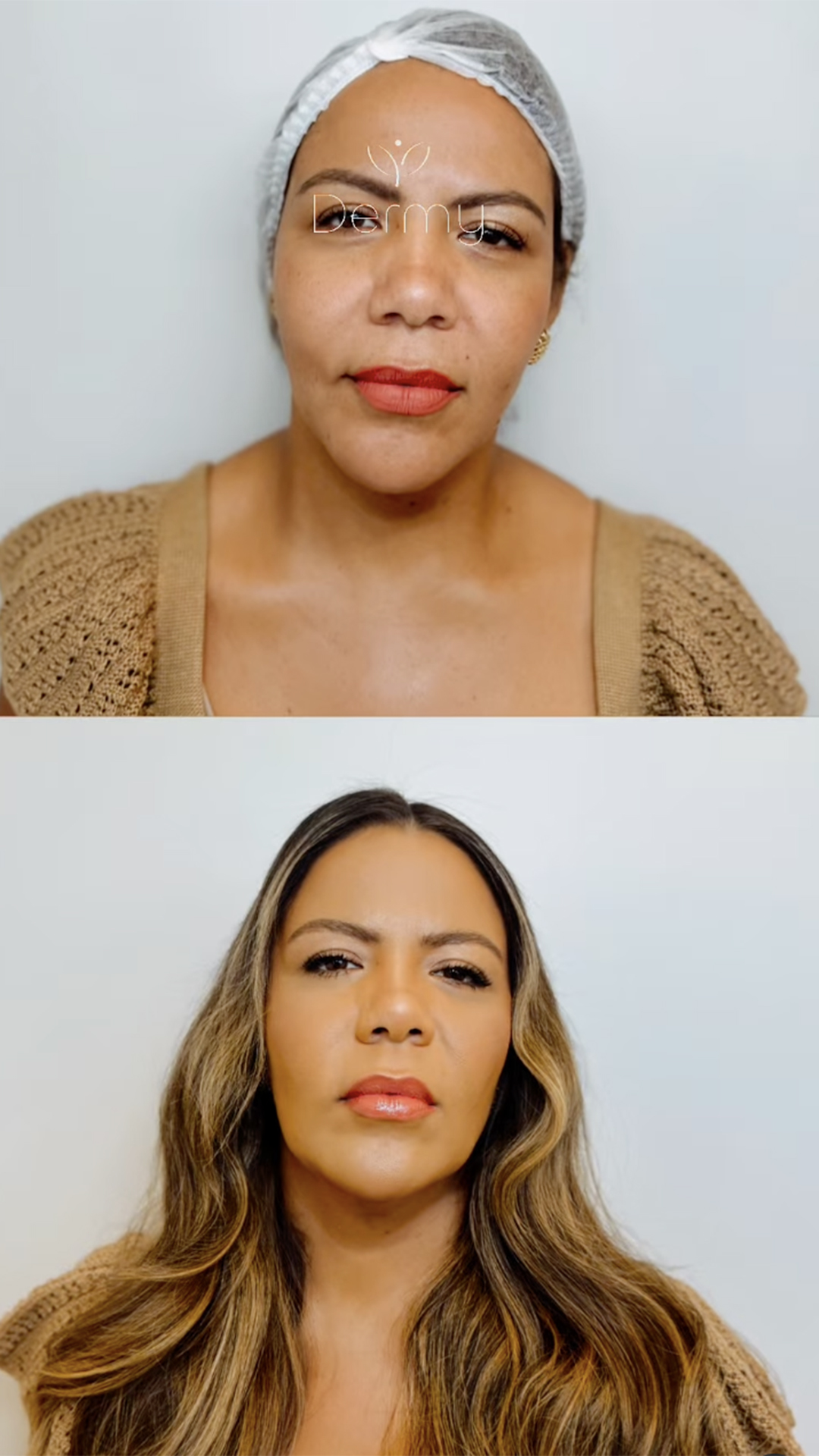 Antes e depois da harmonização facial de Mani Rego - Foto: Reprodução / Instagram