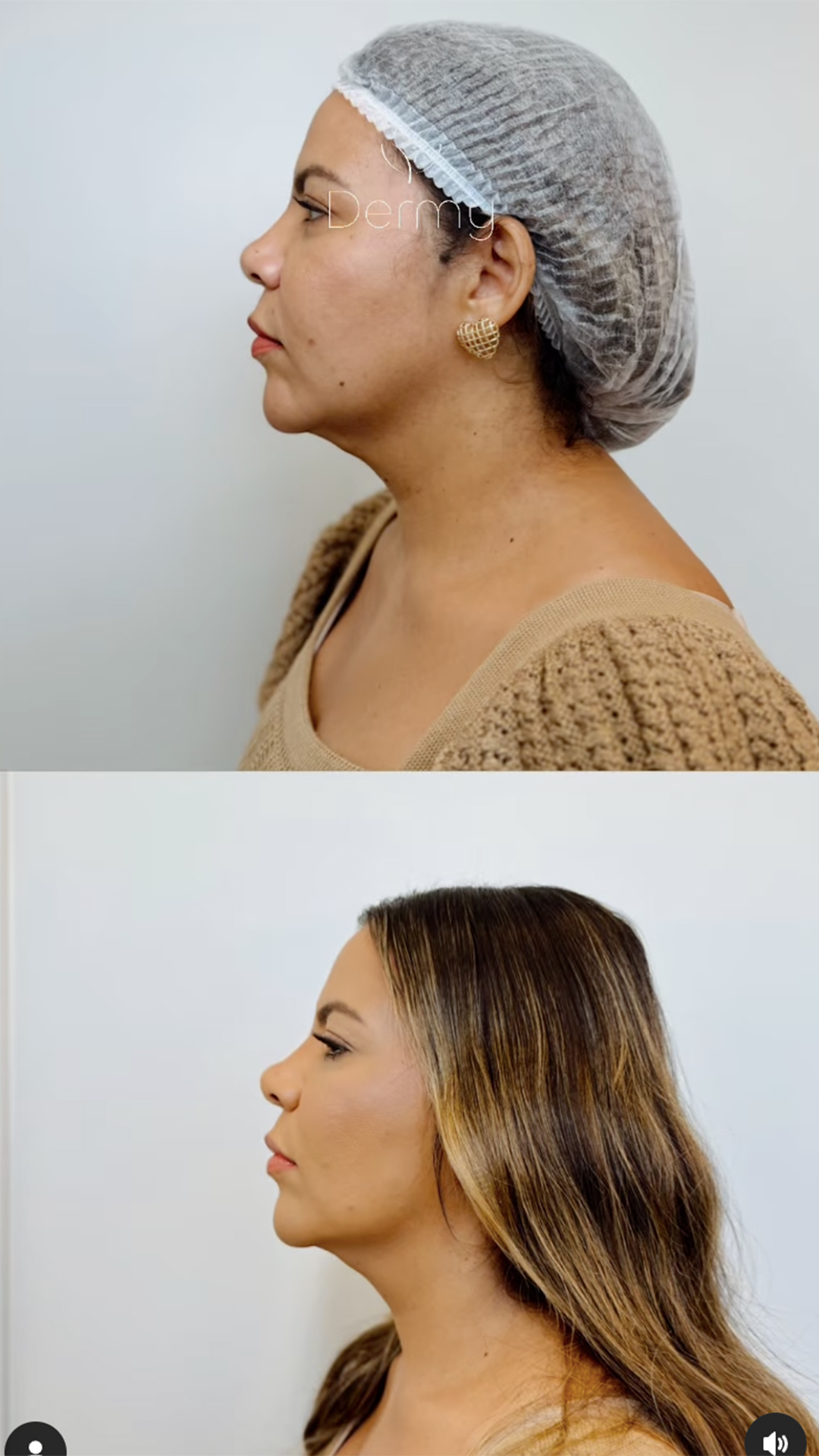 Antes e depois da harmonização facial de Mani Rego - Foto: Reprodução / Instagram