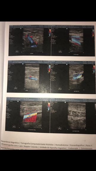 Túlio Gadêlha é diagnosticado com trombose