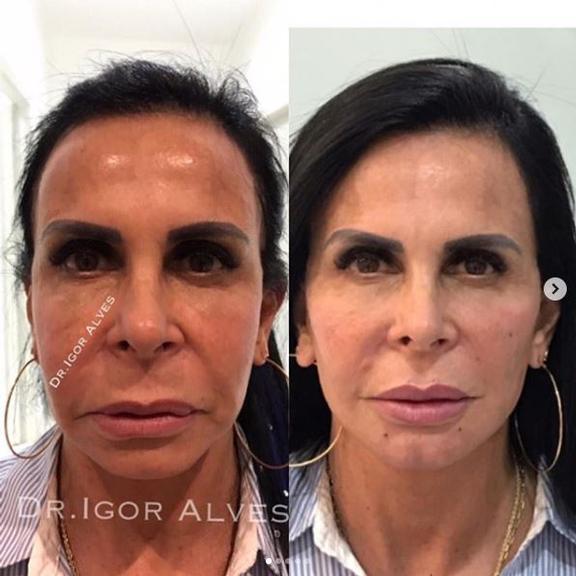 Gretchen realiza procedimento de harmonização facial e choca fãs com mudança