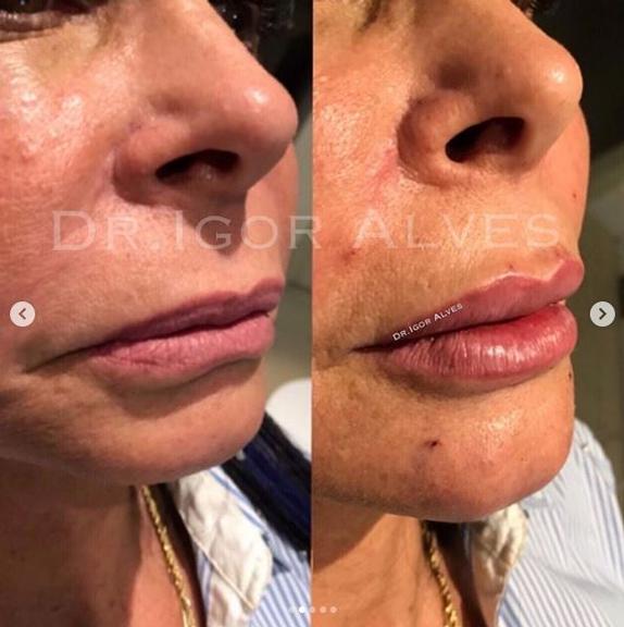 Gretchen realiza procedimento de harmonização facial e choca fãs com mudança