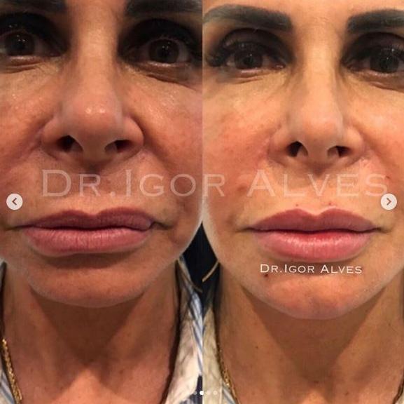 Gretchen realiza procedimento de harmonização facial e choca fãs com mudança