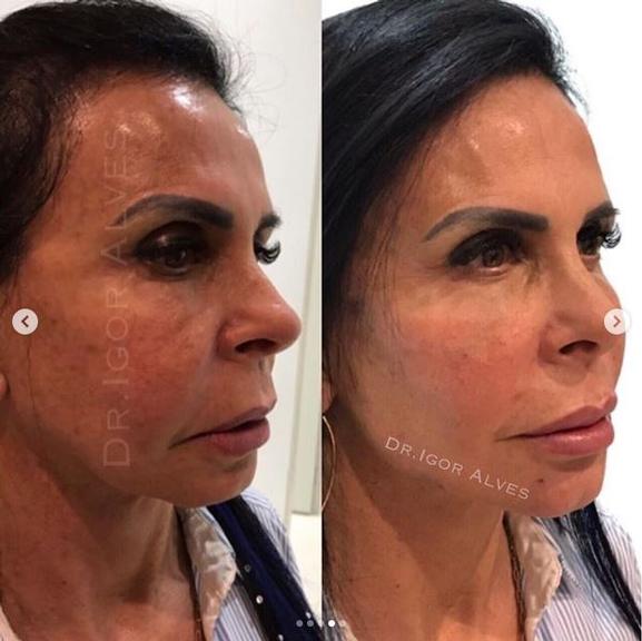 Gretchen realiza procedimento de harmonização facial e choca fãs com mudança