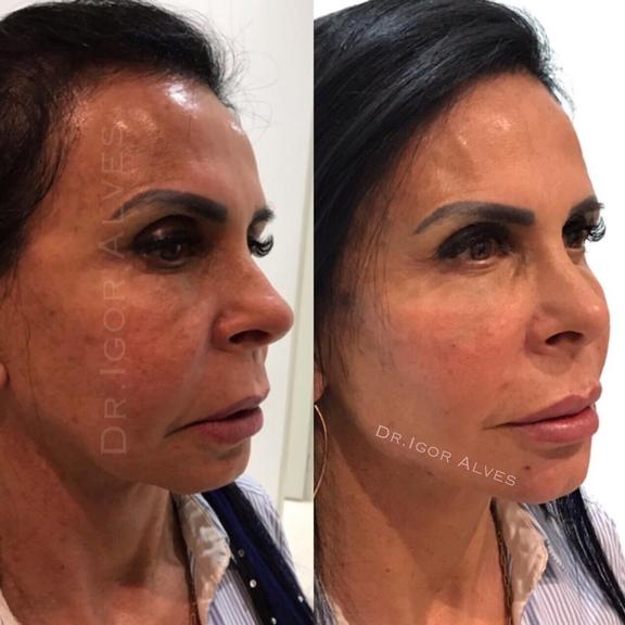 Gretchen não escondeu a harmonização facial