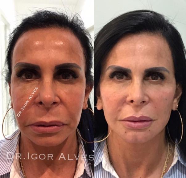 Gretchen não escondeu a harmonização facial