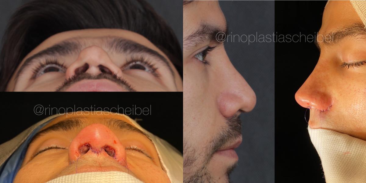 Jakelyne Oliveira e Mariano falam sobre rinoplastia