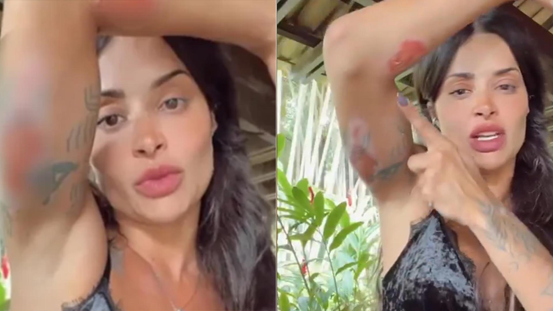 Aline Campos sofre acidente de moto e exibe os machucados