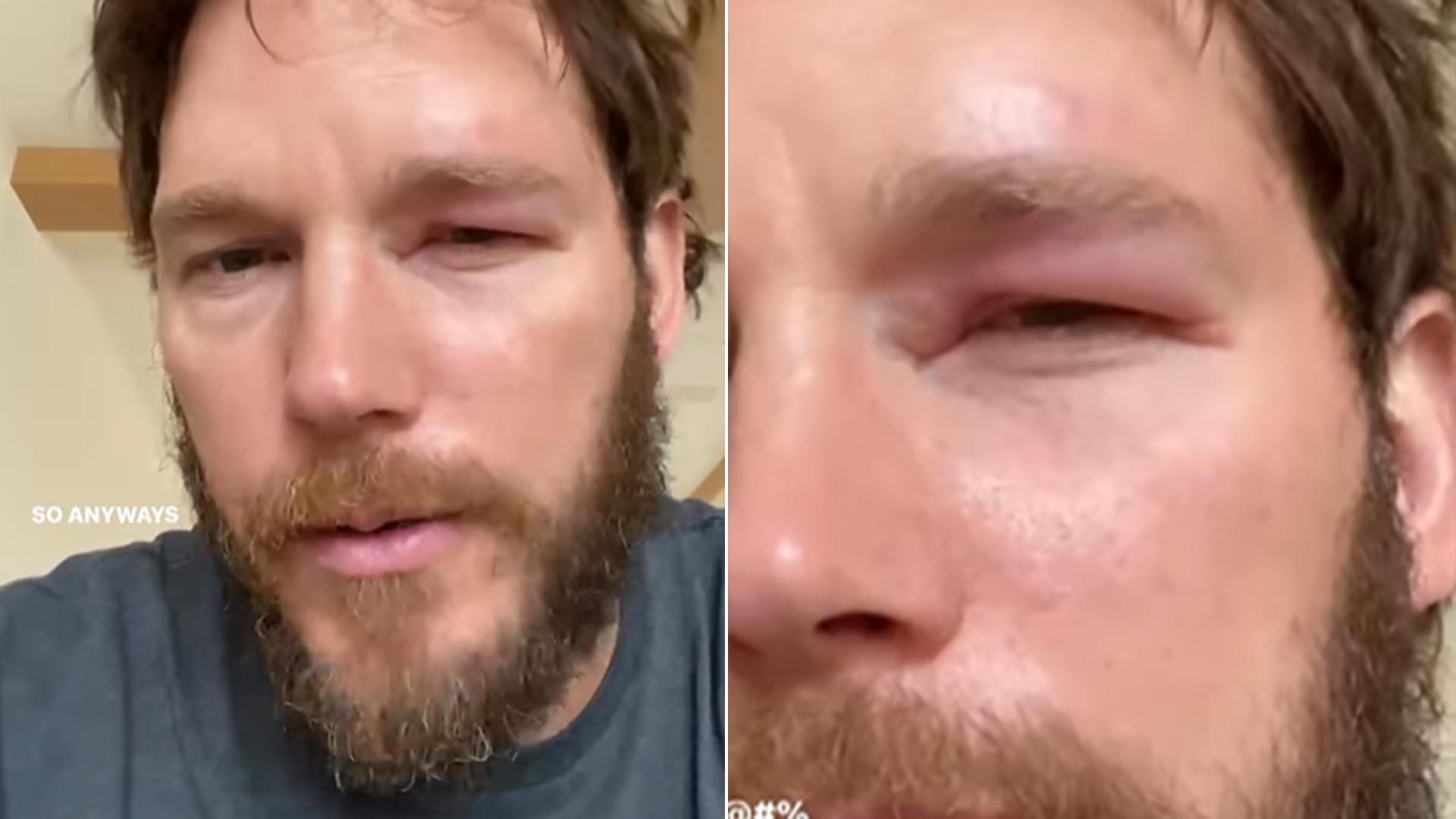 Chris Pratt choca ao exibir o olho inchado e explica o que aconteceu