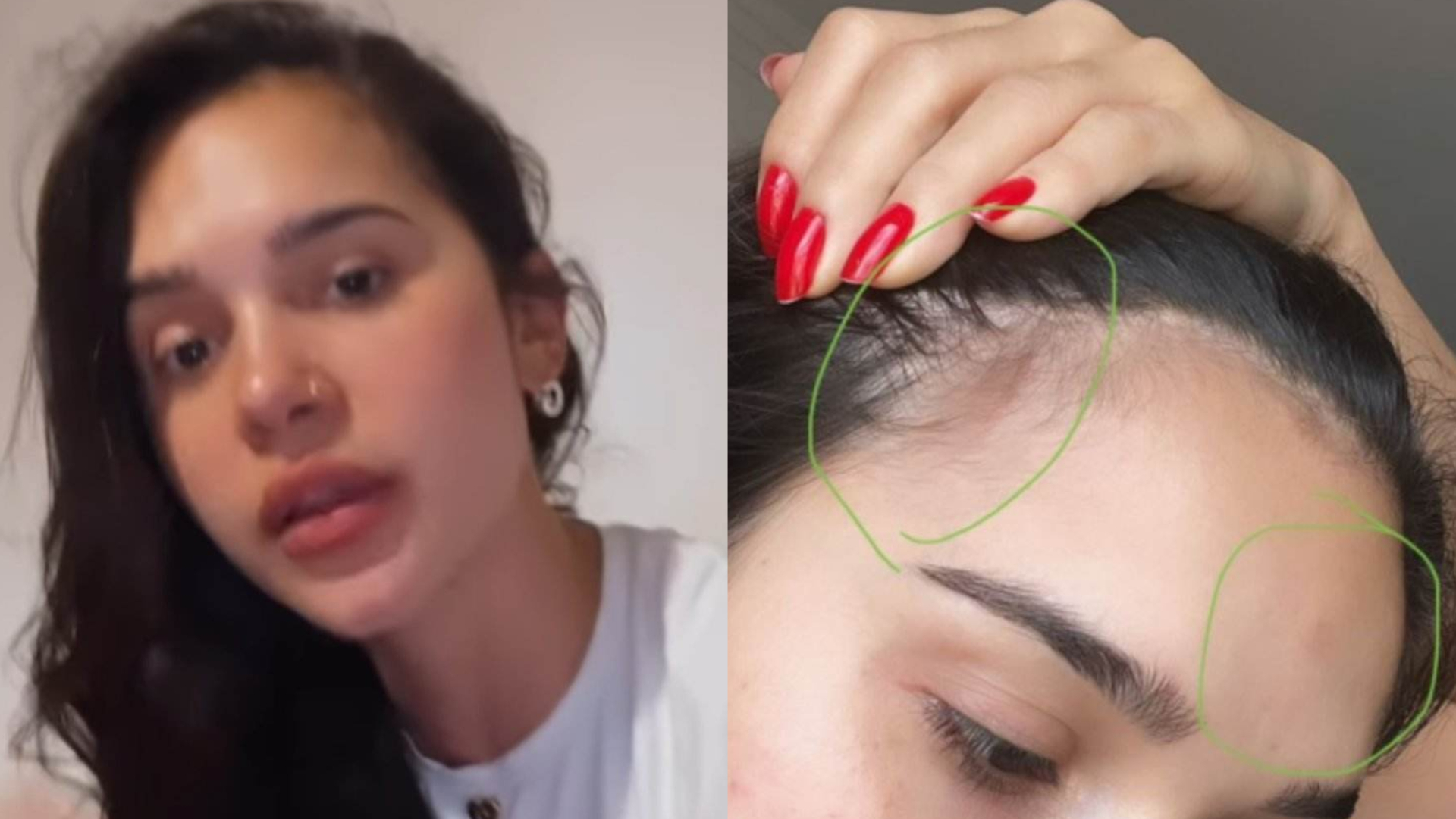 Após acidente, Gizelly Bicalho mostra marcas e relembra momento tenso: ”Quebrei cinco costelas”