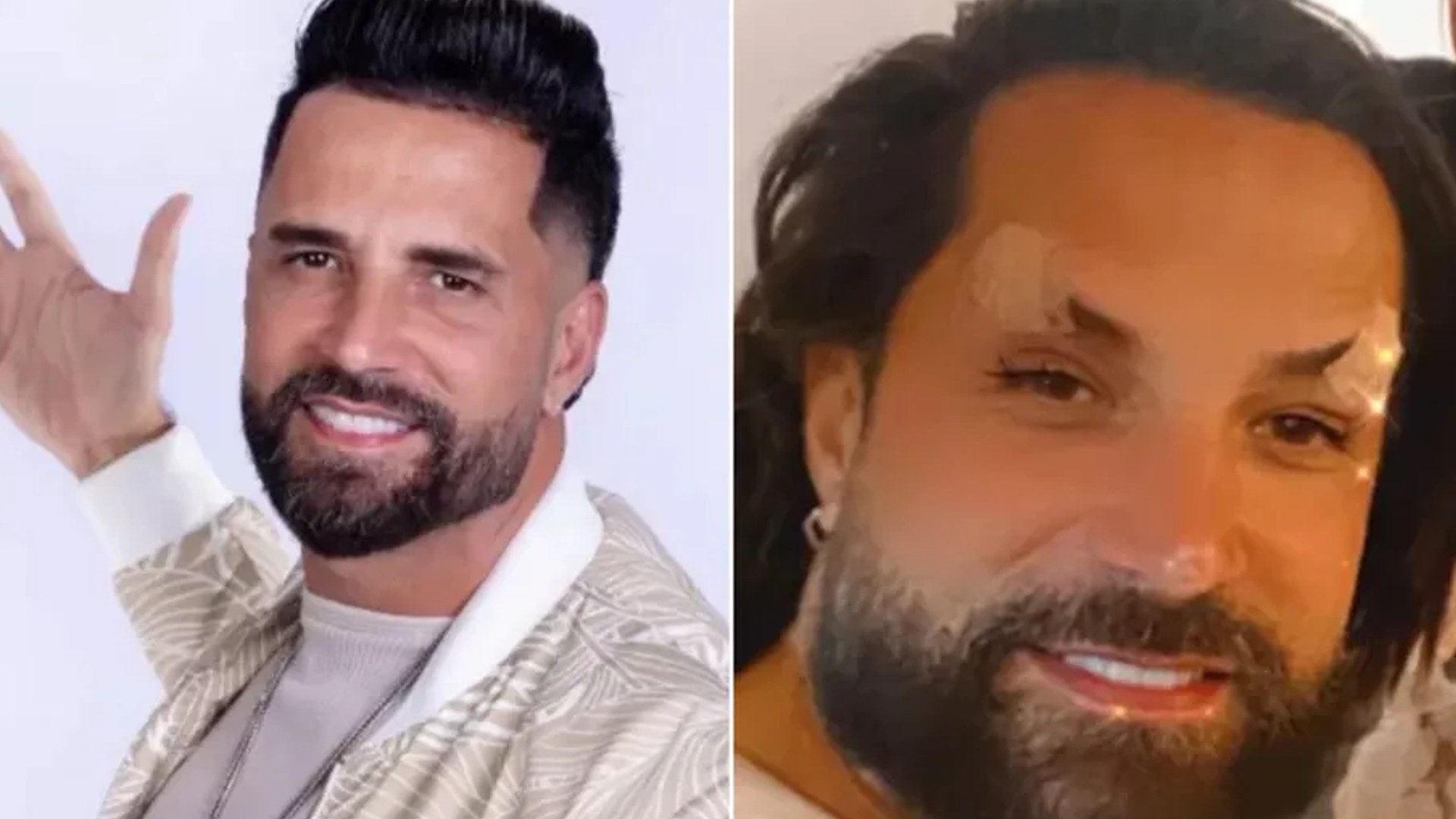 Latino gasta bolada em harmonização facial e fica irreconhecível