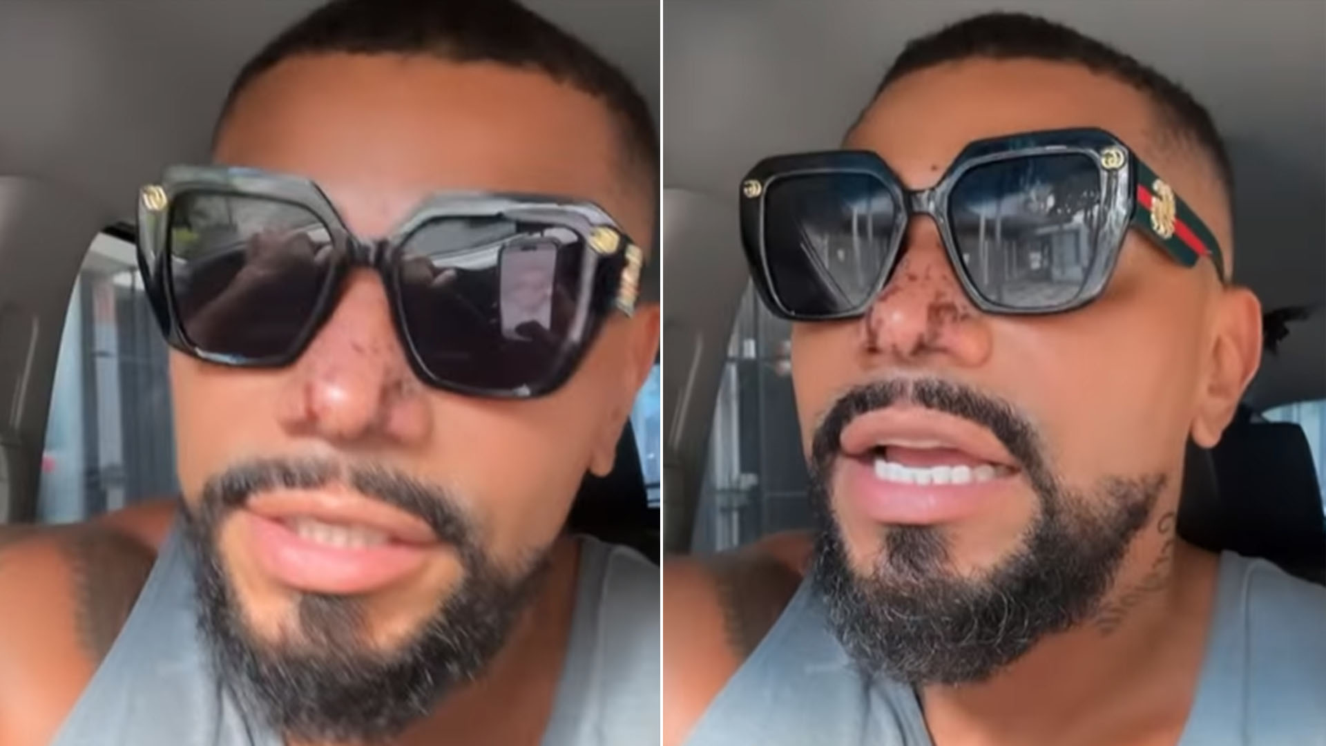 Naldo desabafa após ter princípio de necrose no nariz: ‘Nem queria’